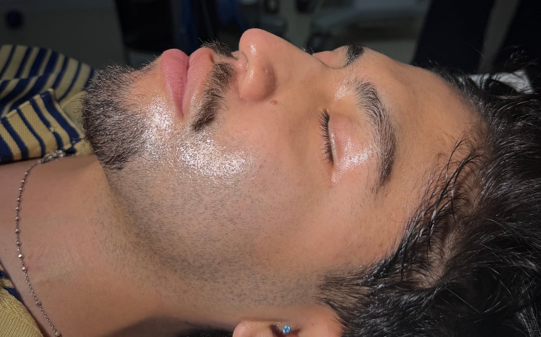 HydraFacial — After