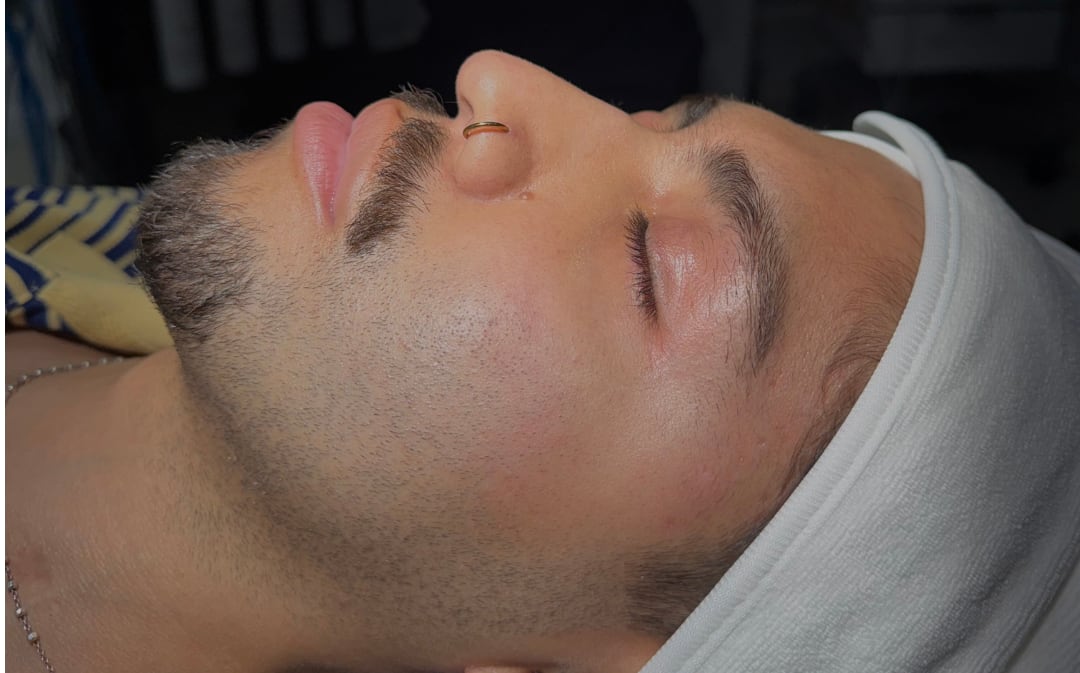 HydraFacial — Before
