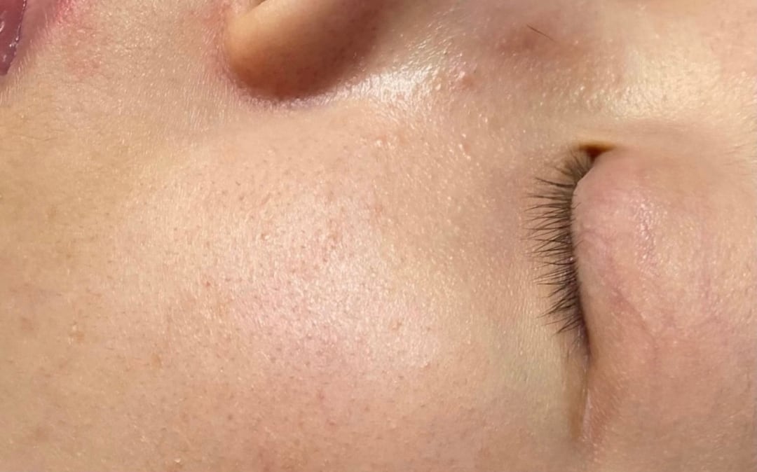 HydraFacial — Before