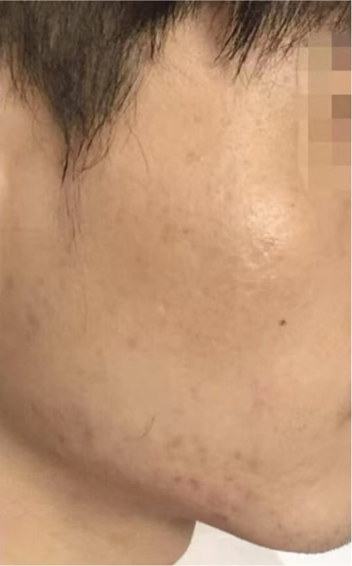 IPL Photofacial + HydraFacial — After