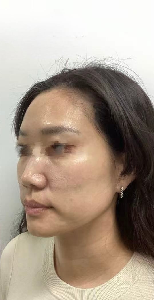 Thermage FLX — After